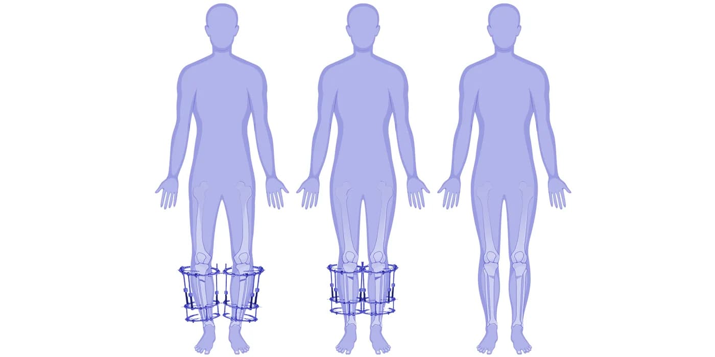 Limb deformity