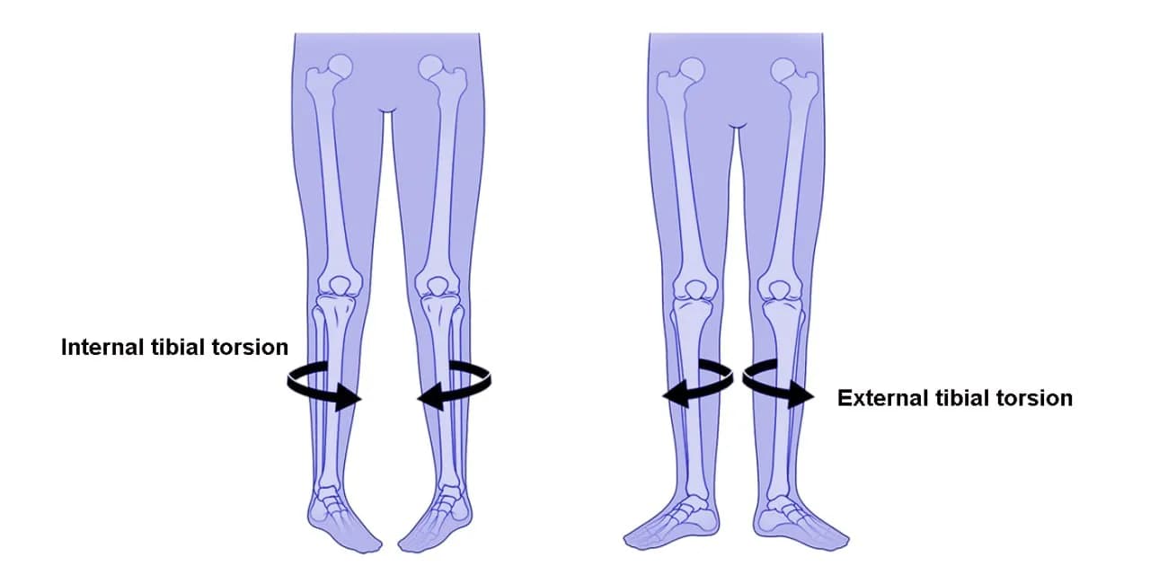 Torsional deformities