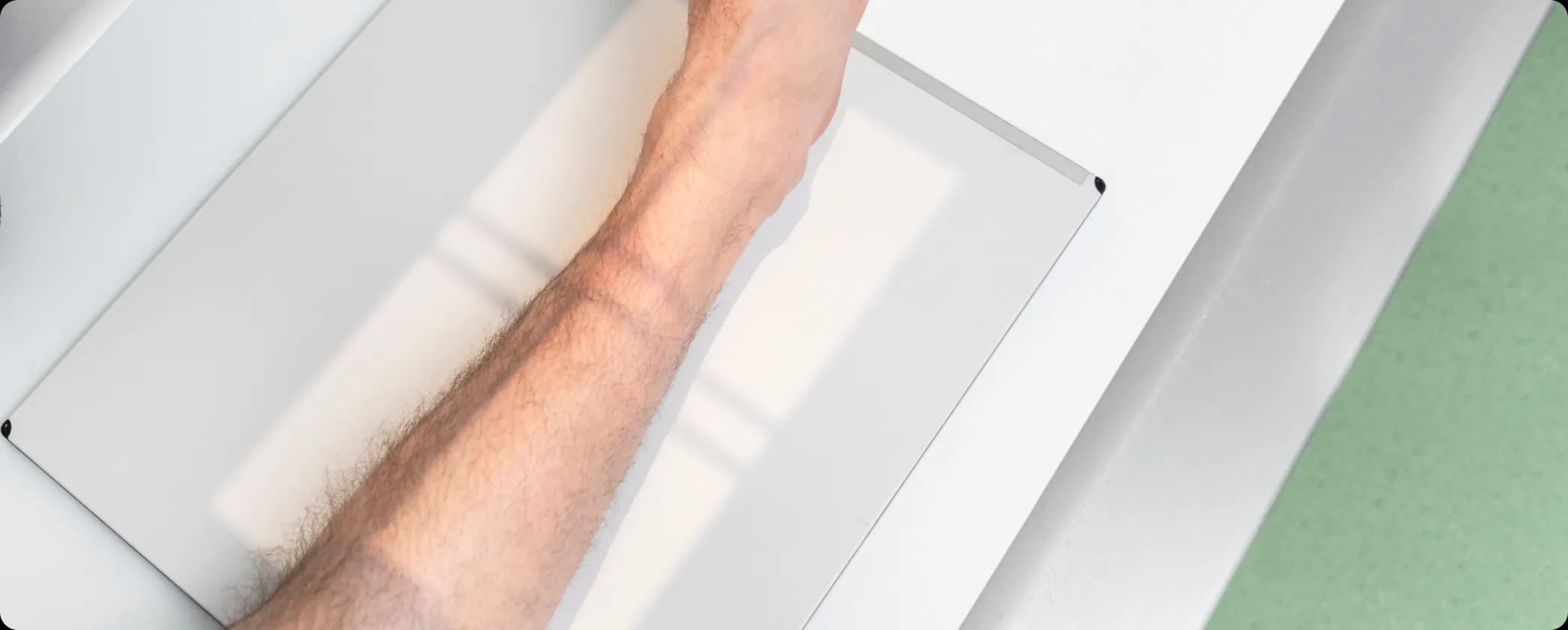 Achondroplasia limb lengthening surgery