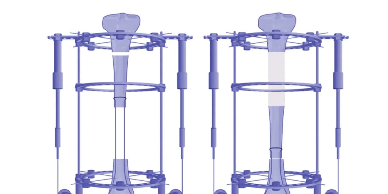 Bone Transport