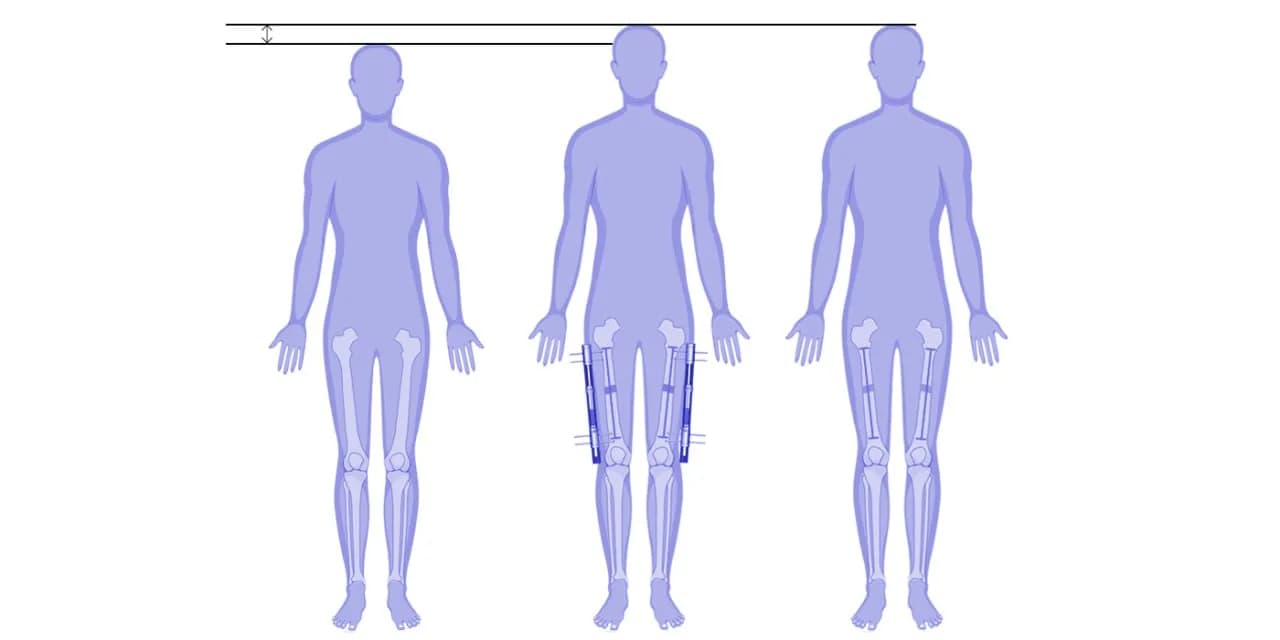 Femur lengthening surgery