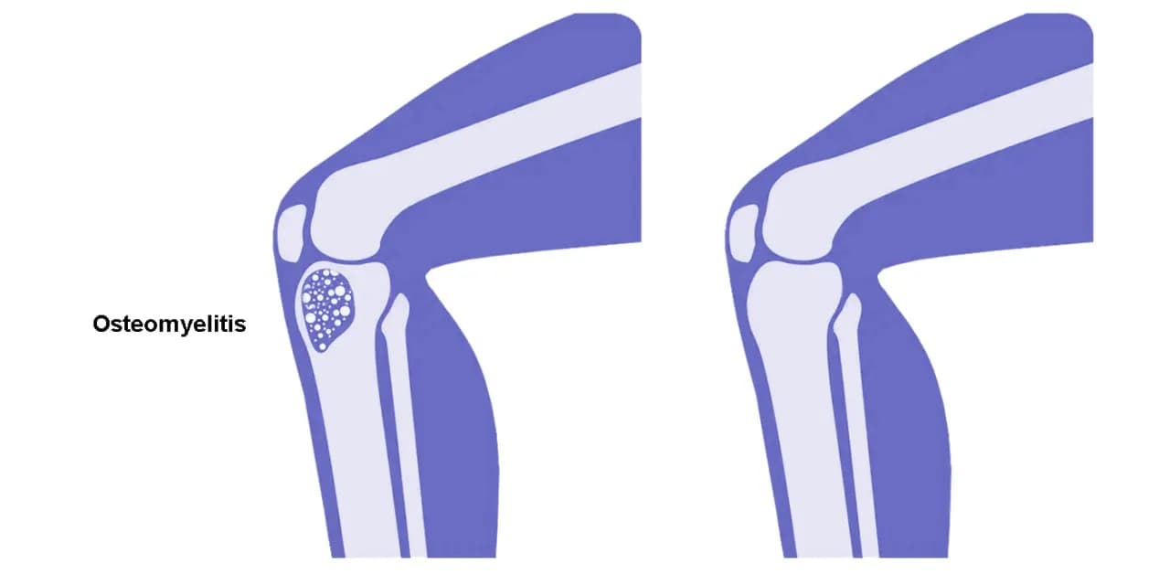 Osteomyelitis