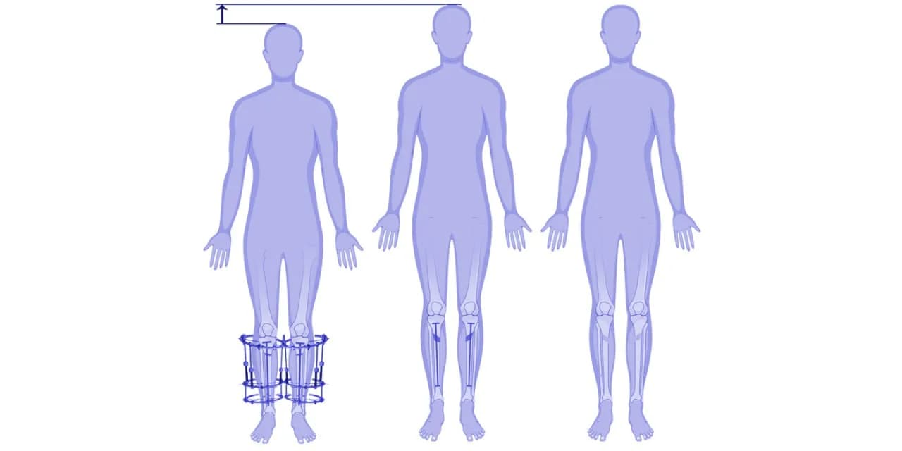 Tibia lengthening surgery